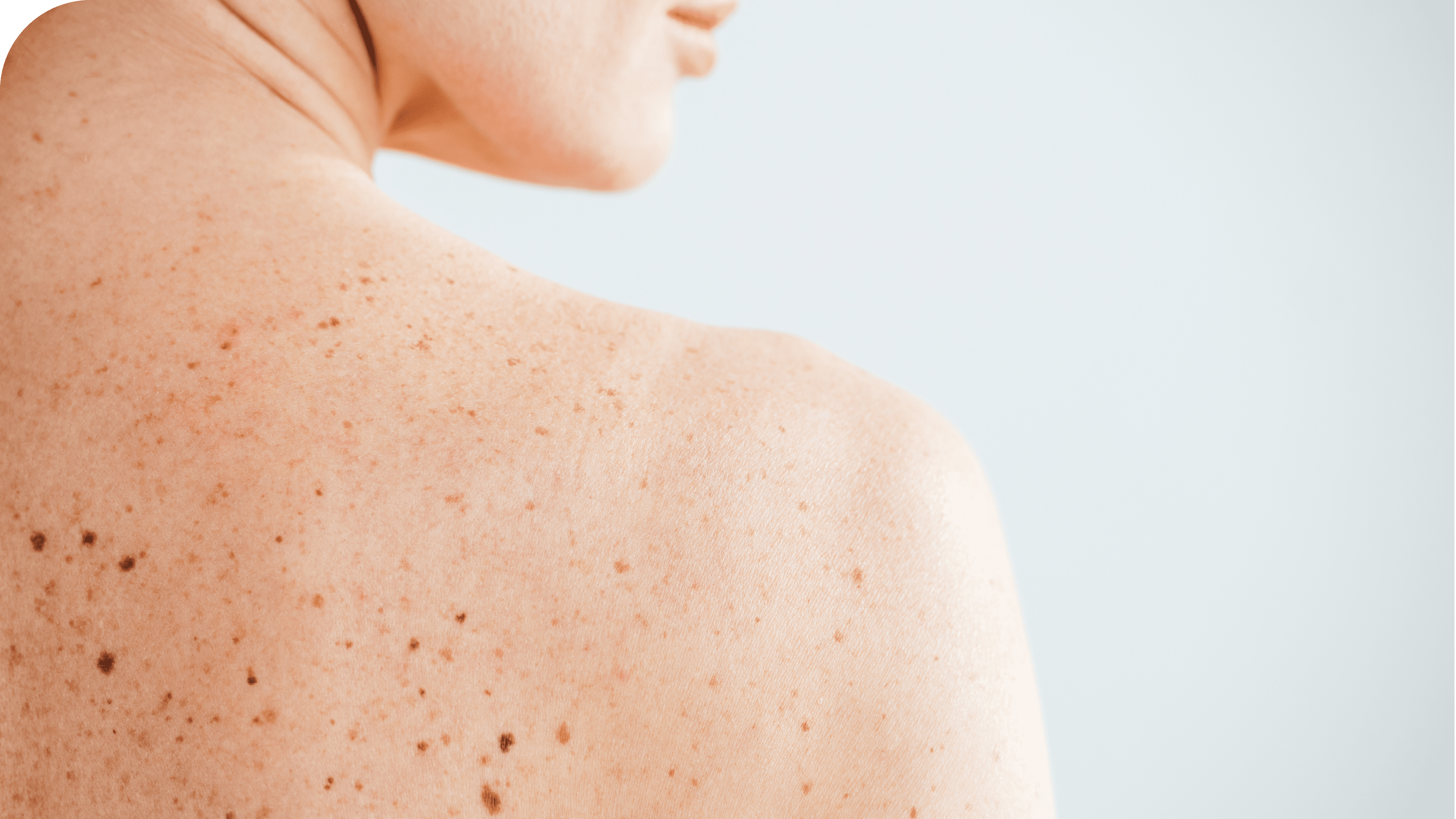 cropped view of diseased and naked woman with moles on skin on white 